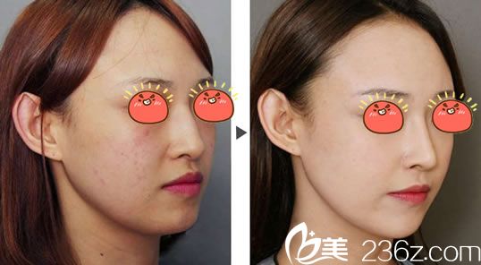 杭州連天美李艷霞祛斑案例 杭州連天美李艷霞祛斑案例