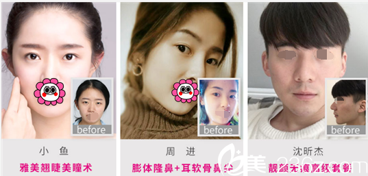 長沙雅美整形醫(yī)院案例對比圖 長沙雅美整形醫(yī)院案例對比圖