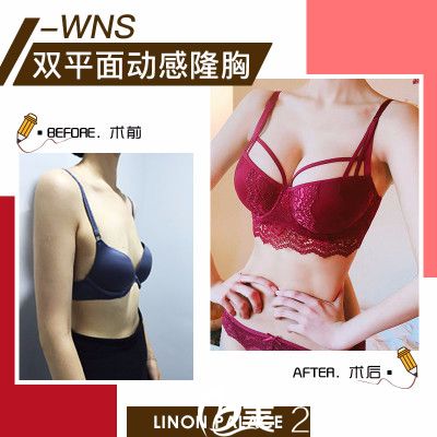 珠海新顏曾超假體隆胸案例對(duì)比圖