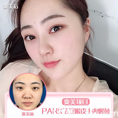 珠海新顏曾超醫(yī)生雙眼皮開眼角案例