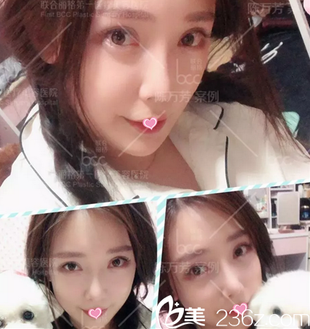 北京聯(lián)合麗格脂肪填充面部一個(gè)月效果 北京聯(lián)合麗格脂肪填充面部一個(gè)月效果