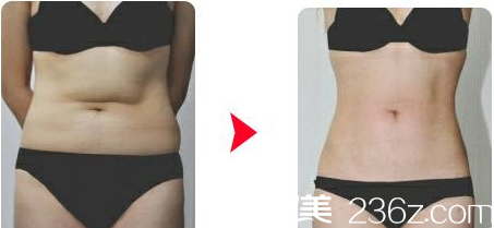 韓國(guó)Re Yeon K整形外科醫(yī)院腰腹部吸脂案例 韓國(guó)Re Yeon K整形外科醫(yī)院腰腹部吸脂案例