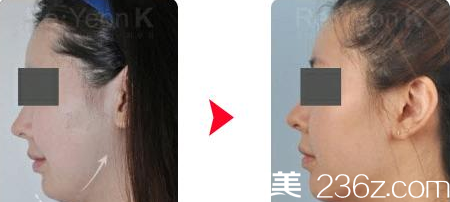 韓國(guó)Re Yeon K整形外科醫(yī)院面部脂肪填充案例 韓國(guó)Re Yeon K整形外科醫(yī)院面部脂肪填充案例