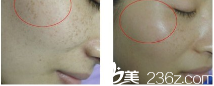 韓國(guó)Re Yeon K整形外科醫(yī)院金賢秀祛斑案例 韓國(guó)Re Yeon K整形外科醫(yī)院金賢秀祛斑案例