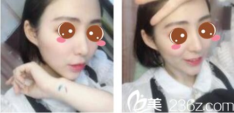 自從去了韓國莫德羅找徐求一做了面部埋線提升，術(shù)后一個月就看起來年輕五六歲