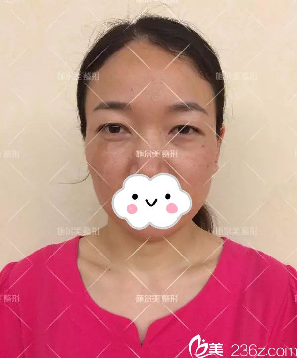 術(shù)前咖啡斑眼部問題較多 術(shù)前咖啡斑眼部問題較多