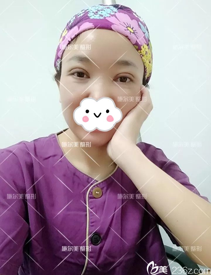 做完眼綜合半個月后恢復(fù) 做完眼綜合半個月后恢復(fù)