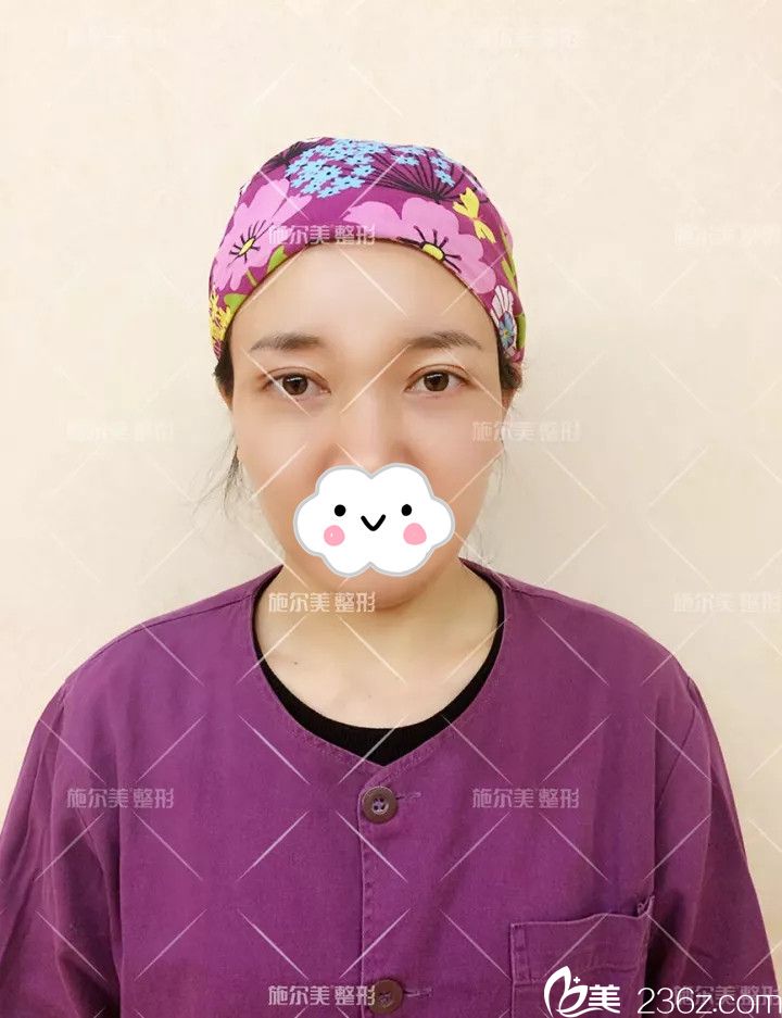 術(shù)后22天眼綜合和皮秒祛斑恢復(fù) 術(shù)后22天眼綜合和皮秒祛斑恢復(fù)