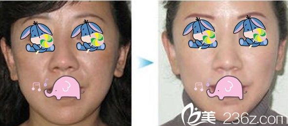 美爾韓整形醫(yī)院面部提升效果案例