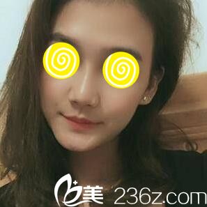 玻尿酸隆鼻術(shù)后第三天效果