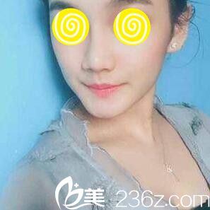 在韓國(guó)藍(lán)天感覺(jué)昨玻尿酸隆鼻第五天效果