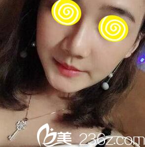 在韓國(guó)注射玻尿酸隆鼻半個(gè)月效果