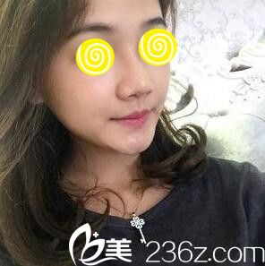 玻尿酸隆鼻效果好不好？看我在韓國(guó)藍(lán)天感覺(jué)整形外科注射玻尿酸隆鼻1個(gè)月效果圖