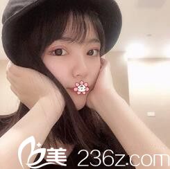 貴陽華美雙眼皮加開內(nèi)眼角術(shù)后一個月