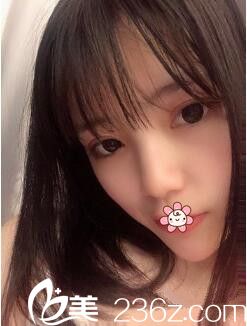 貴陽華美黃皓開內(nèi)眼角加雙眼皮術(shù)后兩個月效果