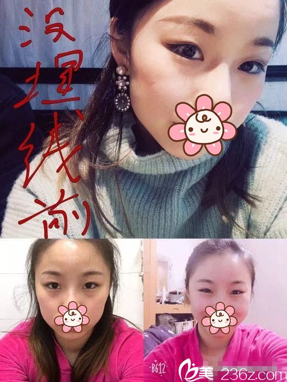 術前內雙想做埋線雙眼皮 術前內雙想做埋線雙眼皮