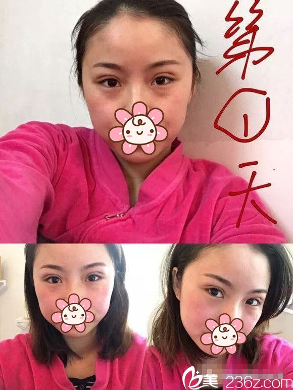 剛做完埋線雙眼皮天腫脹 剛做完埋線雙眼皮天腫脹