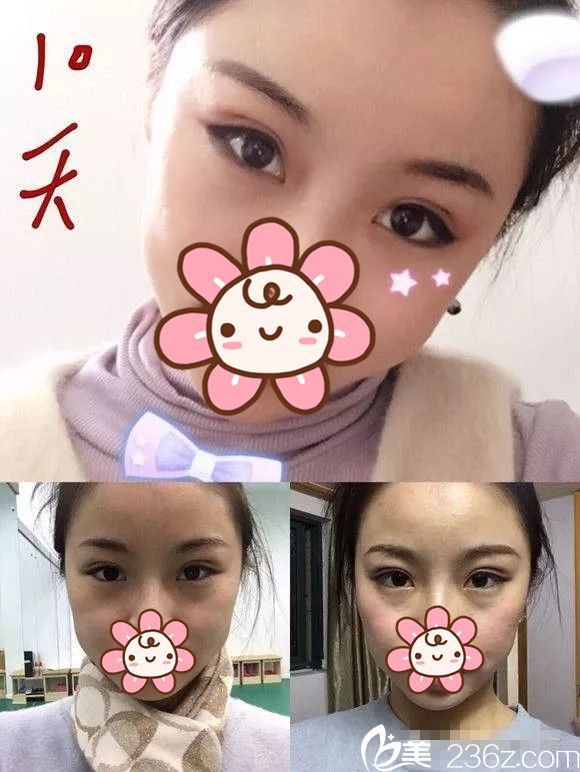 做完埋線雙眼皮十天腫脹不太明顯 做完埋線雙眼皮十天腫脹不太明顯