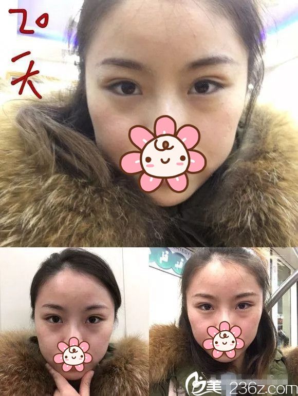 埋線雙眼皮術后20天恢復 埋線雙眼皮術后20天恢復