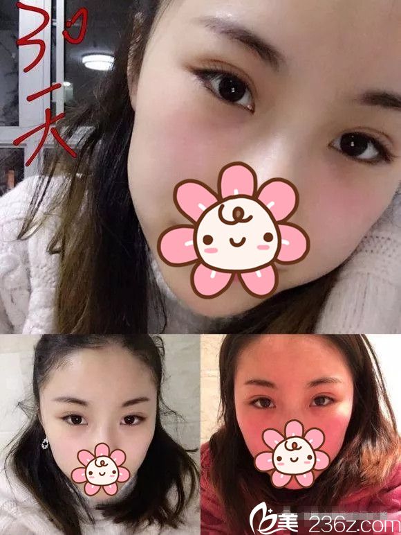 誰(shuí)說內(nèi)雙不能做埋線雙眼皮?看箍牙妹在無(wú)錫同舟術(shù)后一個(gè)月恢復(fù)效果圖
