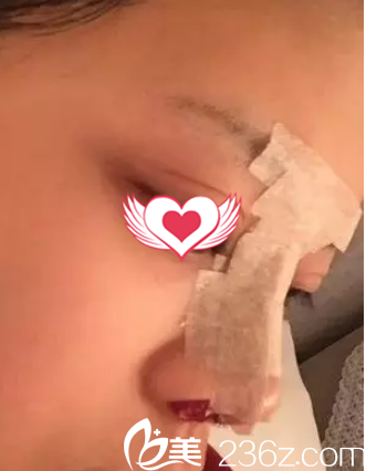 剛做完硅膠隆鼻后鼻子腫脹 剛做完硅膠隆鼻后鼻子腫脹