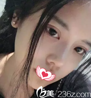 硅膠隆鼻25天鼻子高挺 硅膠隆鼻25天鼻子高挺