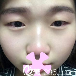 我在太原歐美蓮整形美容醫(yī)院做雙眼皮之前的照片 我在太原歐美蓮整形美容醫(yī)院做雙眼皮之前的照片