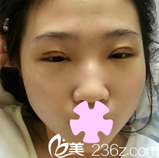 太原歐美蓮姚冰給我做全切雙眼皮術(shù)后第3天照片 太原歐美蓮姚冰給我做全切雙眼皮術(shù)后第3天照片