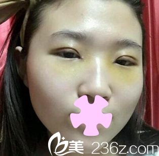 太原歐美蓮姚冰給我做雙眼皮和開眼角術(shù)后第7天照片 太原歐美蓮姚冰給我做雙眼皮和開眼角術(shù)后第7天照片