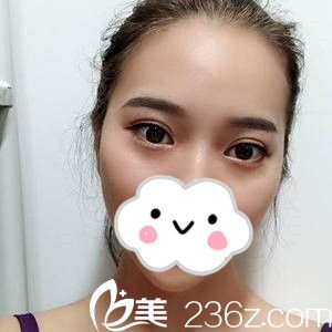哈爾濱雙眼皮哪家好？看我找黃振華院長(zhǎng)做的全切雙眼皮一個(gè)月恢復(fù)過(guò)程，自然無(wú)痕連我媽都驚呆了