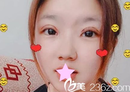 割雙眼皮第四天 割雙眼皮第四天