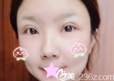 切開雙眼皮第七天拆線后圖片 切開雙眼皮第七天拆線后圖片