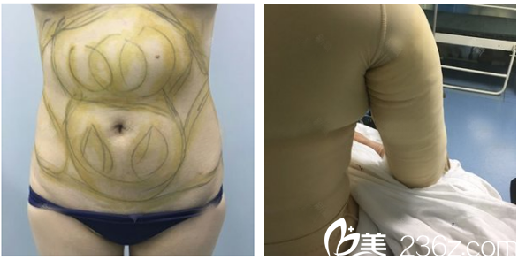廣州美萊王志軍腰腹部吸脂術(shù)前 廣州美萊王志軍腰腹部吸脂術(shù)前