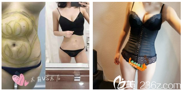 廣州美萊王志軍腰腹部抽脂案例對(duì)比圖 廣州美萊王志軍腰腹部抽脂案例對(duì)比圖