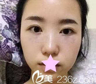 蘭州時光整形醫(yī)院內(nèi)切去眼袋手術前 蘭州時光整形醫(yī)院內(nèi)切去眼袋手術前