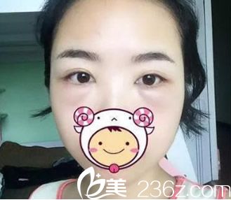 內(nèi)切去眼袋第2天 內(nèi)切去眼袋第2天