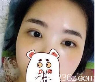 去眼袋第4天 去眼袋第4天