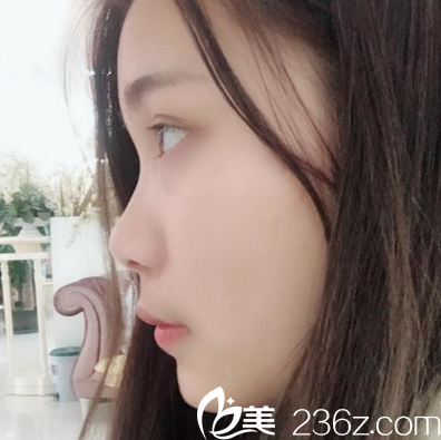 廣州美萊劉豪隆鼻案例術(shù)前 廣州美萊劉豪隆鼻案例術(shù)前