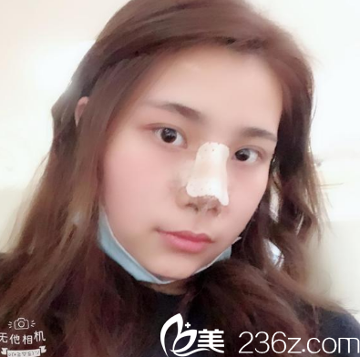 鼻綜合隆鼻術(shù)后四天效果圖 鼻綜合隆鼻術(shù)后四天效果圖