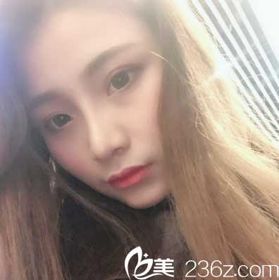 廣州美萊鼻綜合隆鼻術(shù)后10天 廣州美萊鼻綜合隆鼻術(shù)后10天