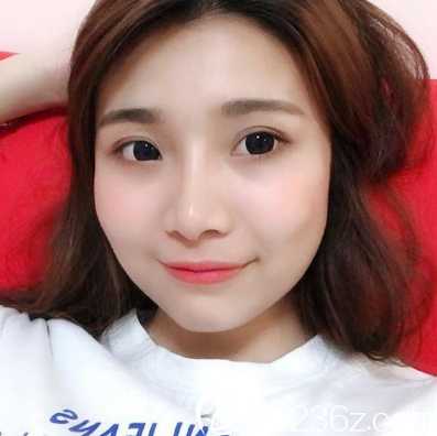 廣州美萊劉豪隆鼻兩個月自拍 廣州美萊劉豪隆鼻兩個月自拍