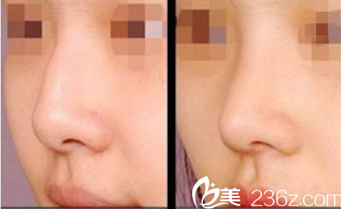 隆鼻前后對(duì)比 隆鼻前后對(duì)比