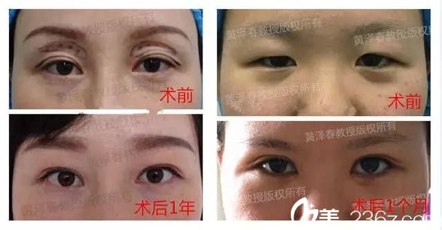 廣州美萊黃澤春做雙眼皮的圖片 廣州美萊黃澤春做雙眼皮的圖片