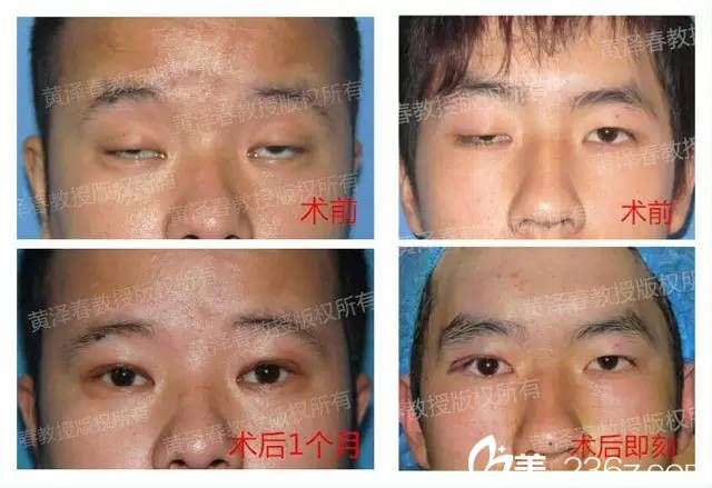廣州美萊黃澤春修復(fù)雙眼皮圖片 廣州美萊黃澤春修復(fù)雙眼皮圖片