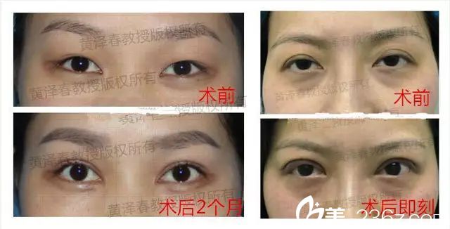 廣州美萊黃澤春修復(fù)雙眼皮案例 廣州美萊黃澤春修復(fù)雙眼皮案例