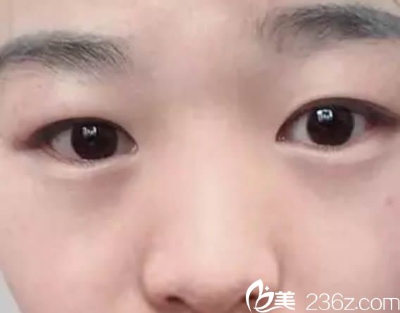 在廈門歐菲整形醫(yī)院做雙眼皮術前照 在廈門歐菲整形醫(yī)院做雙眼皮術前照