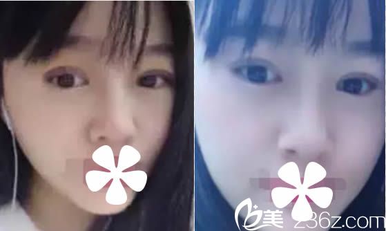 假體隆鼻和切開雙眼皮15天 假體隆鼻和切開雙眼皮15天