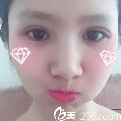 黃澤春雙眼皮修復(fù)案例術(shù)后7天拆線