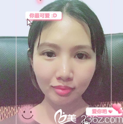 找黃澤春做完雙眼皮修復(fù)兩周圖片