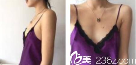 韓國樸賢整形外科樸賢自體脂肪隆胸真人案例術(shù)前照 韓國樸賢整形外科樸賢自體脂肪隆胸真人案例術(shù)前照